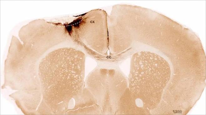 뇌졸중을 겪은 뒤 인간신경줄기세포 이식을 받은 실험실 쥐 뇌의 관상면 단면. 점선 원은 뇌졸중 부위이며, 이식된 인간신경줄기세포의 신경돌기(짙은 갈색)가 피질(CX)까지 국소적으로 뻗어 있을 뿐만 아니라, 뇌량(CC)을 통해 반대쪽 뇌반구까지 뻗어 있다. 취리히대학교 제공