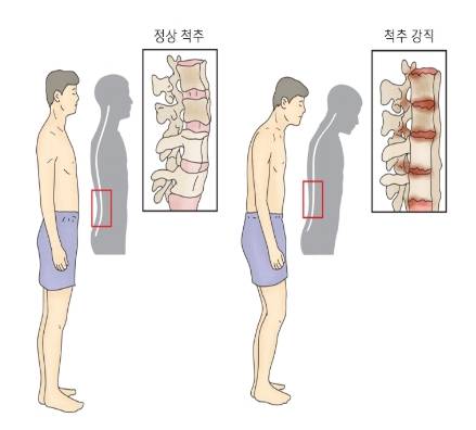 정상인(왼쪽)과 강직성 척추염 환자(오른쪽)이 척추 모양 비교. /자료=서울아산병원 건강정보