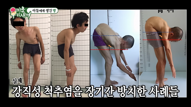 강직성 척추염은 주로 척추와 엉치엉덩관절(천장관절)을 침범하는 만성적인 염증성 관절염이다. 심하면 허리를 펴지 못하고 다니게 된다. SBS 예능 ‘미운 우리 새끼’