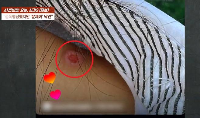 경북 영주의 한 특성화고 1학년 A양의 몸에 B군이 담배빵을 한 사진. (사진=JTBC 사건반장)