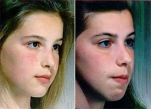 구호흡과 관련해 유명한 자매입니다. 오른쪽은 구호흡을 방치하여 얼굴 모양이 나빠진 모습입니다. 구호흡이 얼굴 모양을 악화시킨다는 근거로 자주 이용되는 사진입니다.