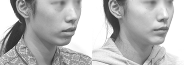 턱끝이 뒤로 빠지고 입이 벌어지며 중안면이 길어 보이는 얼굴은 턱끝이 앞으로 나와 외모가 개선되며, 호흡을 편하게 만듭니다.