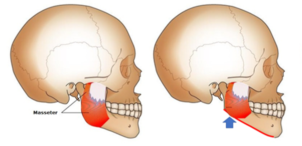 사각턱을 줄이는 수술은 근육의 긴장을 줄여 턱관절의 부담을 완화시킵니다.