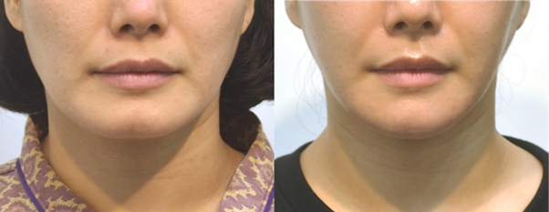 수년간 이갈이와 턱관절 통증으로 여러 치료를 받았지만 효과가 미미했던 환자입니다. 사각턱 수술 후에 턱관절 통증에서 해방되어 하루하루가 행복하다고 말씀하셔서 의사마저 행복하게 하셨습니다.