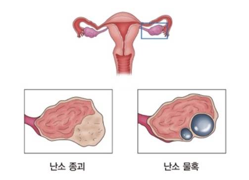 난소 낭종. 자료 : 서울아산병원