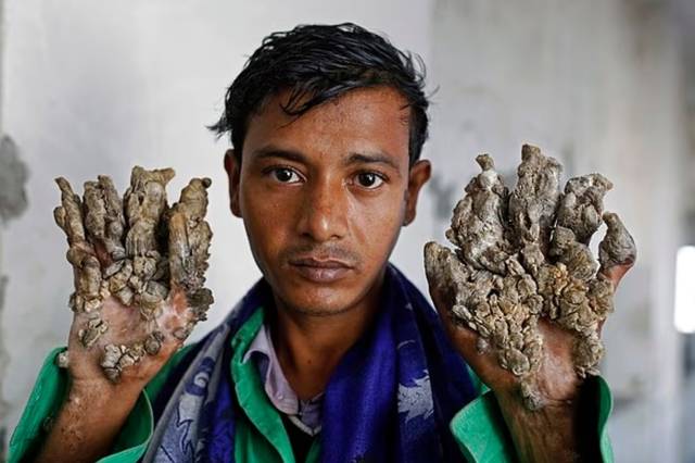 나무인간 증후군을 앓는 방글라데시의 아불 바잔다르. 뉴시스