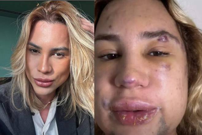 브라질의 인스타그램 인플루언서이자 패션 스타일리스트로 활동하던 아데이르 멘데스 두트라 주니어(31)가 이른바 '여우 눈(Fox Eyes)' 시술 후 심각한 감염에 시달리다 숨졌다. 사진=주니어 두트라의 SNS