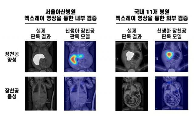 신생아 장천공 인공지능 판독 모델은 복강 내 공기가 차 있는 영역 등을 정확히 식별하며 장천공 여부를 판별했다(제공=서울아산병원)