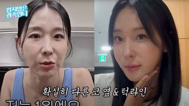 가수 이지혜의 실리프팅 시술 전후 비교 사진/'밉지않은 관종언니' 유튜브 캡쳐