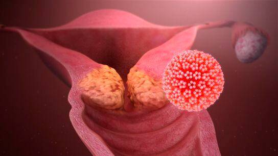 자궁경부암을 유발하는 인유두종바이러스(HPV) 모식도. /위키미디어