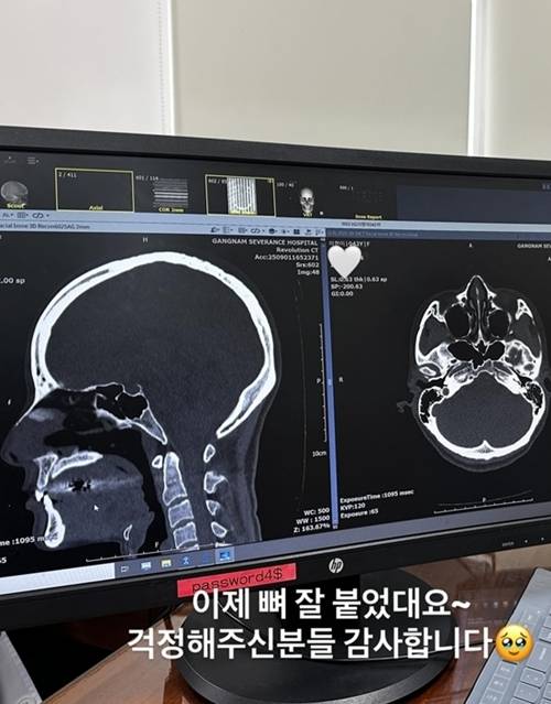 모델 겸 방송인 이현이가 축구 경기 중 코뼈 골절 부상을 당해 입원 치료를 받았다. 사진=SNS