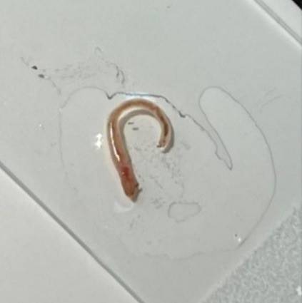 지렁이 [임상사례보고(Clinical Case Reports)]