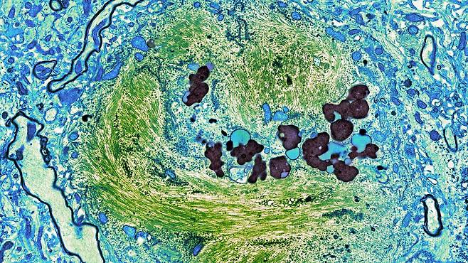 알츠하이머병 환자의 뇌세포에서 타우 단백질이 엉킨 덩어리(녹색). 스위스 로슈는 혈중 타우 단백질을 찾아 인지 기능 저하자가 알츠하이머병 환자가 아님을 확인하는 혈액 검사법을 개발했다./미 국립 현미경 및 영상연구센터(NCMIR)