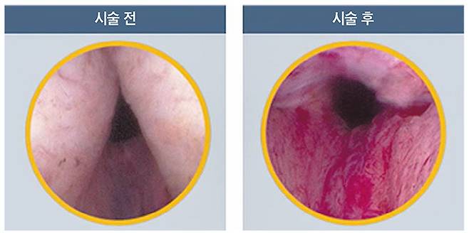 전립선비대증으로 좁아져 있던 요도(왼쪽)가 유로리프트 시술 후 넓어진 모습(오른쪽). /칸비뇨의학과의원 제공