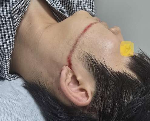 안산시 물축제에서&nbsp;워터건에 맞아 다친 피해자