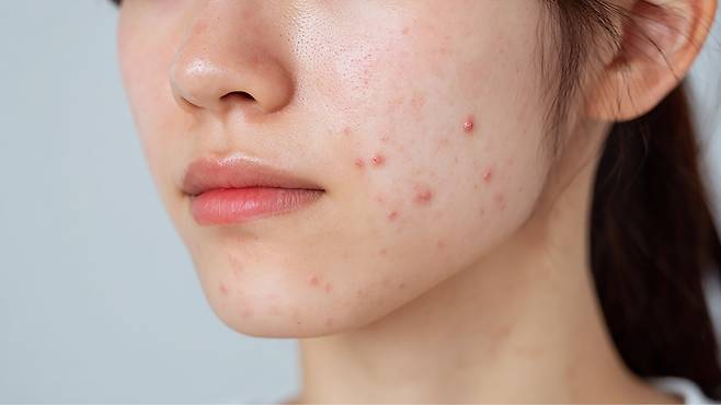 여드름 치료제는 피부를 건조하게 만들 수 있으므로 보습 관리가 중요하다|출처: 클립아트코리아