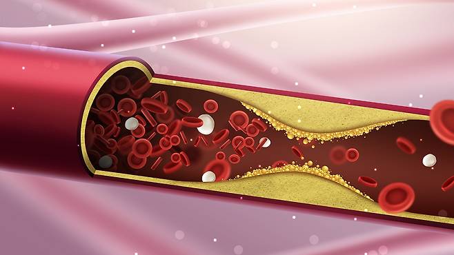 고지혈증은 혈액 속 콜레스테롤과 중성지방 수치가 정상 범위를 초과한 상태를 말한다｜출처: 클립아트코리아