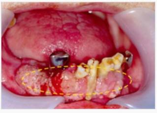 아랫 잇몸에 생긴 구강암 병변. /사진=서울대병원