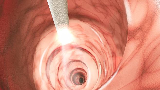 대장내시경은 가장 좋은 암 예방 수단이다｜출처: 게티이미지뱅크