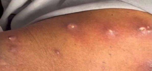 피내구더기증에 걸린 인도 남성의 모습. 사진=American Journal of Medical Science and Innovation