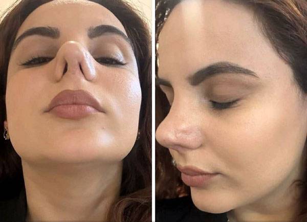 세 차례에 걸친 코 성형 수술 후 심각한 호흡 문제와 만성적인 감염으로 고통받고 있는 한 여성의 사연이 전해졌다./사진=니드투노우