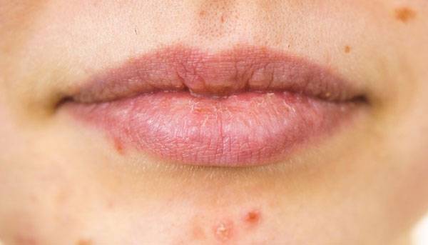 입술은 각질층이 얇고 피지선이 거의 없어 외부 자극에 특히 민감하다​. 립 제품을 쓸 때 피부 반응을 관찰하고 이상이 생기면 즉시 사용을 중단해야 한다.​/사진=클립아트코리아