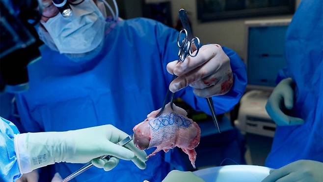 2024년 11월 미국 뉴욕대 랑곤 병원 의료진은 유전자 편집 돼지의 신장을 사람에게 이식하는 수술을 시행했다. 하지만 수술 약 5개월 후인 2025년 4월 이식한 신장의 기능이 멈추면서 결국 몸에서 신장을 제거해야 했다. NYU Langone Health 제공