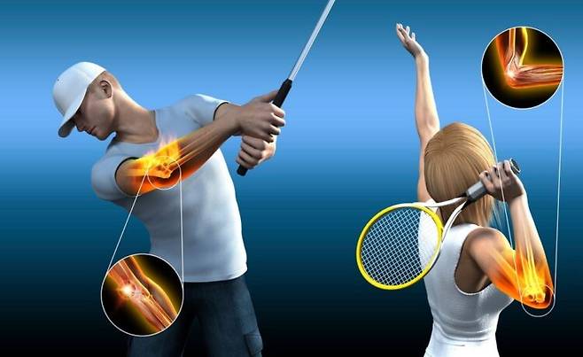 골프엘보는 팔꿈치 안쪽 힘줄에, 테니스엘보는 팔꿈치 바깥쪽 힘줄에 염증이 생긴 것. 사진=클립아트코리아