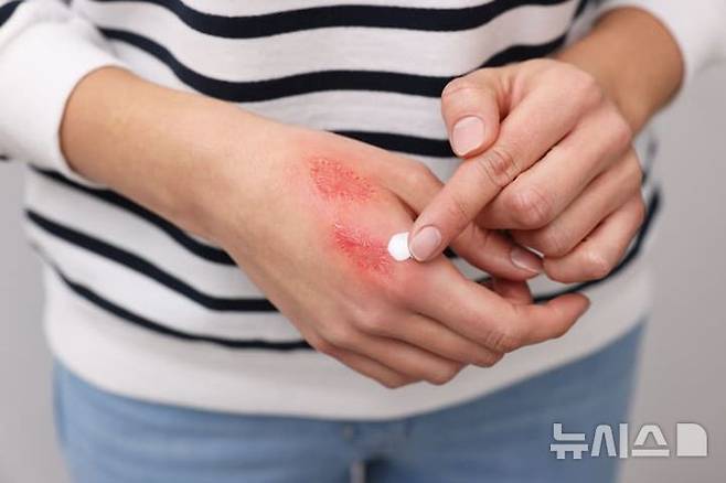 [서울=뉴시스] 화상으로 손상된 피부는 세균 감염의 주요 통로가 되어 패혈증으로 이어질 수 있다. (사진= 한림대학교의료원 제공)