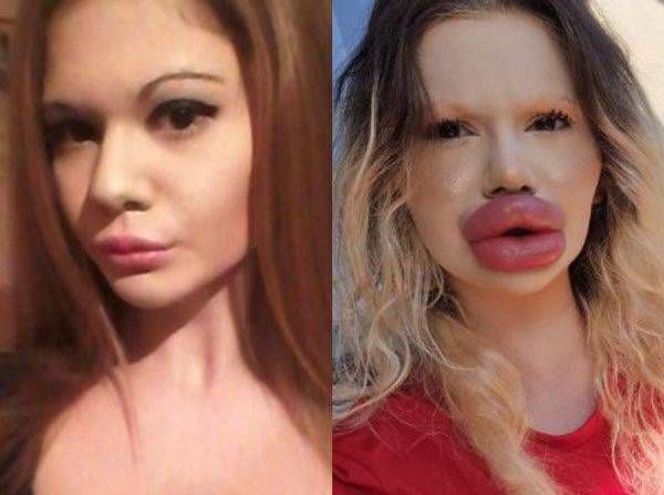 입술 필러 부작용을 호소한 20대 여성. 사진=니드투노우, 헬스조선