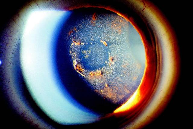 포도막염./클립아트코리아/