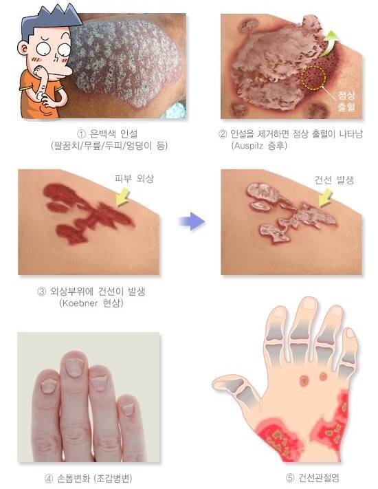 건선의 증상. 국가건강정보포털