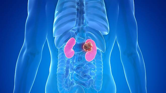 만성콩팥병은 초기 증상이 없어 더욱 위험하다｜출처: 클립아트코리아