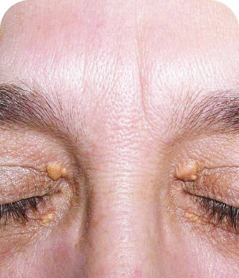 관상동맥 질환눈꺼풀 안쪽에 생기는 황색종
