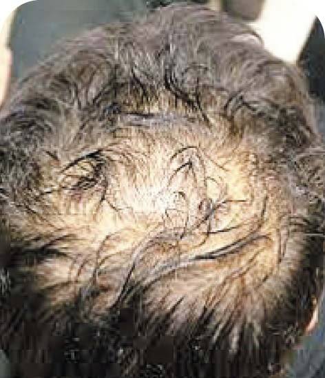 심혈관 질환정수리 탈모