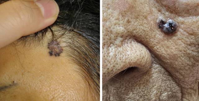 얼굴 부위에 나타나는 기저세포암 병변 모습. 피부암 중에서 가장 흔하며 전이 가능성도 낮다. 경대연합의원 제공