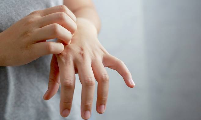 겨울철 건조해진 손 피부를 가려워하는 모습. 게티이미지뱅크