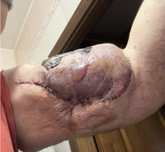 러시아 종합격투기 선수 키릴 테레신(29)의 수술 받은 팔 상태. [인스타그램 갈무리]