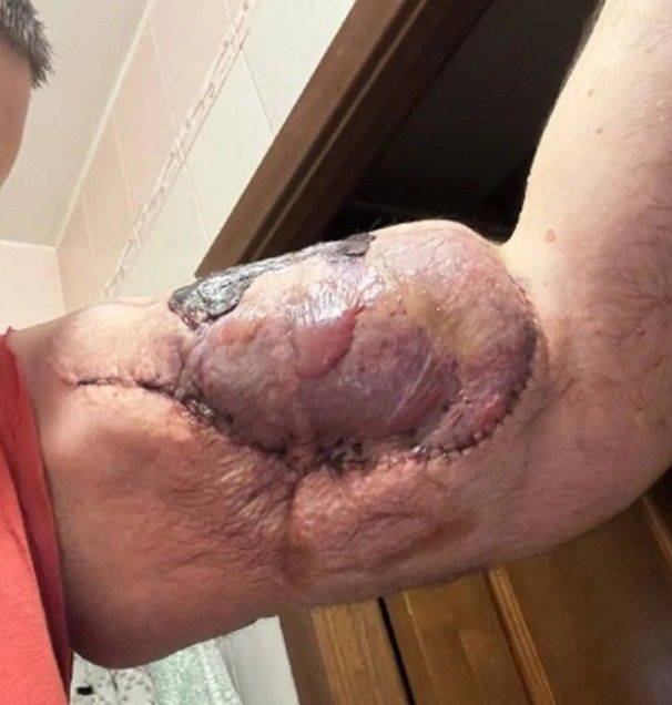 [뉴시스]종합격투기 선수인 키릴 테레신(29남)의 팔 상태. (사진 = rukibazukiofficial1996 인스타그램 캡처) *재판매 및 DB 금지