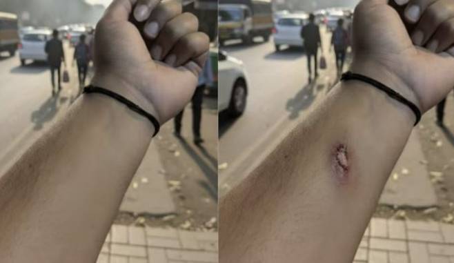 구글 인공지능(AI) 이미지 편집 도구인 나노바나나로 몇 초 만에 편집된 팔 부상 사진. 링크드인 캡처