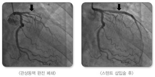급성 심근경색 환자의 관상동맥 스텐트 삽입술 전(왼쪽)과 후(오른쪽) 비교. /사진=질병관리청 국가건강정보포털