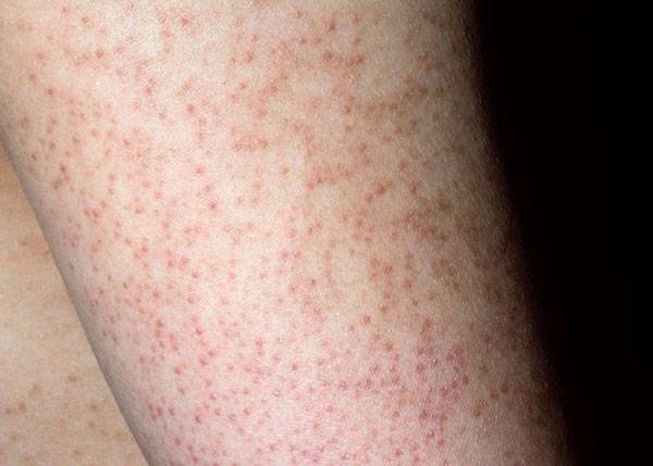 피부에 '닭살' 처럼 보이는 모공각화증을 완화하려면 피부 보습 유지에 신경 써야 한다./사진=클립아트코리아