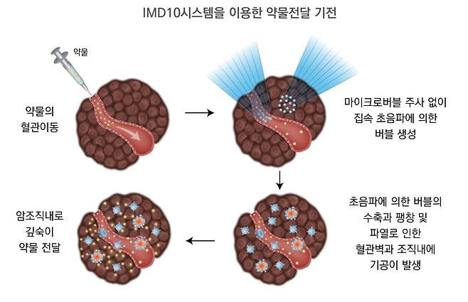 아이엠지티가 개발한 세계 최초 집속 초음파 활용 췌장암 치료 의료기기의 기전. 아이엠지티 제공