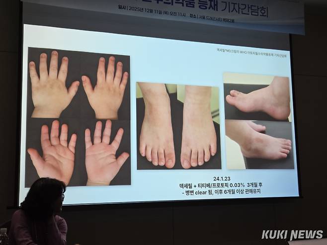 피에르파브르 코리아가 11일 서울 드래곤시티에서 개최한 ‘덱세릴 MD크림’ WHO 필수의약품 등재 기념 기자간담회에서 임상현장 치료 결과가 소개됐다. 신대현 기자