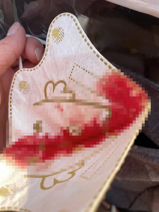 지난 2022년 김해 지역의 한 보건소에서 5세 아동이 PCR 검사 후 코피를 흘려 마스크가 젖었다는 사진. 사진은 기사와 무관. [김해 지역 온라인 커뮤니티]