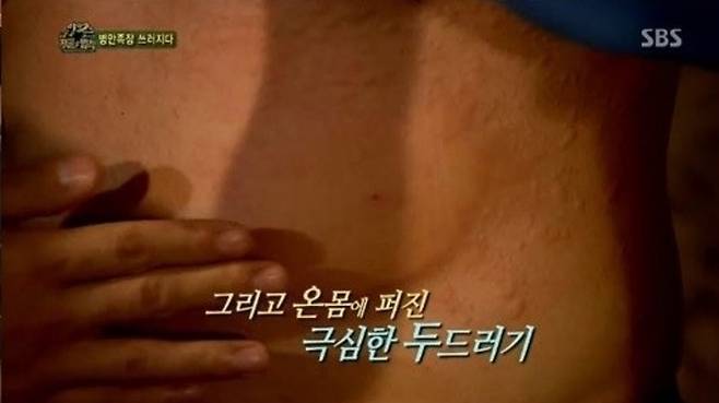 김병만이 겪은 아나필락시스 증상. 사진|SBS ‘정글의 법칙’