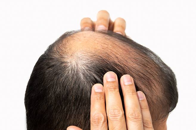 An illustration showing a man with hair loss (Getty Image Bank)