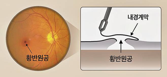한 장의 내경계막으로 원공을 덮을 때 눈 단면의 모습. /그래픽=최우연