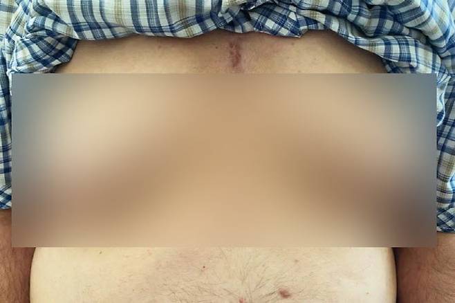 고혈압약 부작용으로 유방이 커진 76세 남성. (사진=뉴잉글랜드의학저널)
