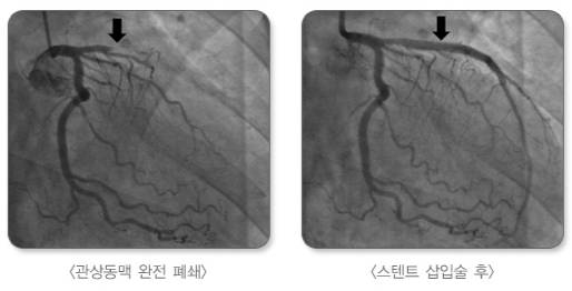 급성 심근경색 환자의 관상동맥이 완전히 막힌 병변(왼쪽)과 스텐트 삽입술 후 다시 개통된 관상동맥(오른쪽). /자료=국가건강정보포털